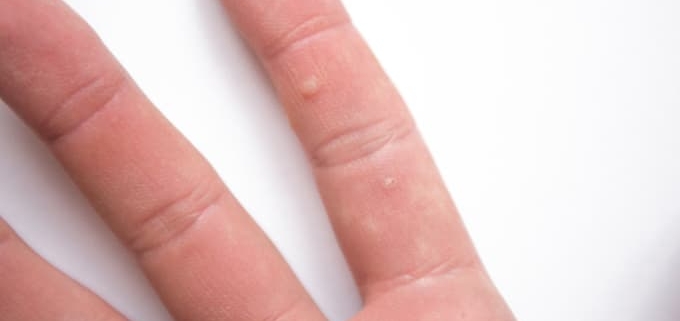 Voorbeeld wratten op de hand